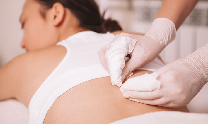 Akné na zádech, ramenou a v dekoltu: Jak se ho zbavit