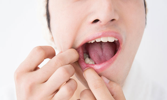 Co pomáhá na afty? Tipy, které přinesou úlevu