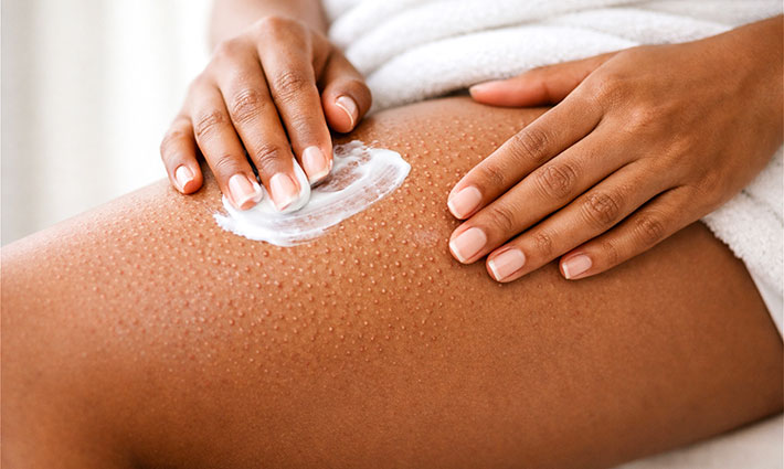 Keratóza pilaris: Proč vzniká a jak ji řešit?